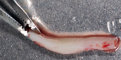 Рис. 5д. Оценка толщины и качества трансплантата