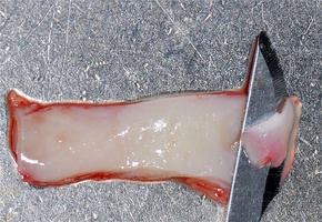 Рис. 5е. Деэпителизация аутотрансплантата