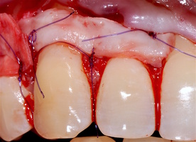 Рис. 5л (правая половина). Фиксация аутотрансплантата и ТМО (dura mater) в области рецессии