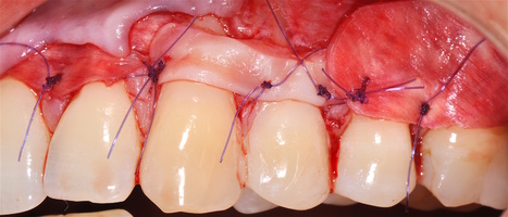 Рис. 5и. Ушивание операционной раны