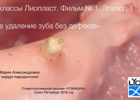 Операция 1. Консервация лунки зуба при удалении корня или разрушенного зуба