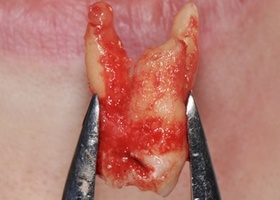 Операция 6. Разобщение оро-антрального соустья, образо-вавшегося при удалении зуба