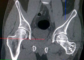 Травматический вывих левого бедра с переломом головки бедренной кости