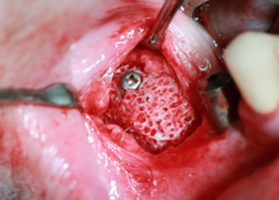 Применение костных аутотрансплантатов и индивидуальных аллогенных костных блоков при атрофии альвеоляра нижней челюсти